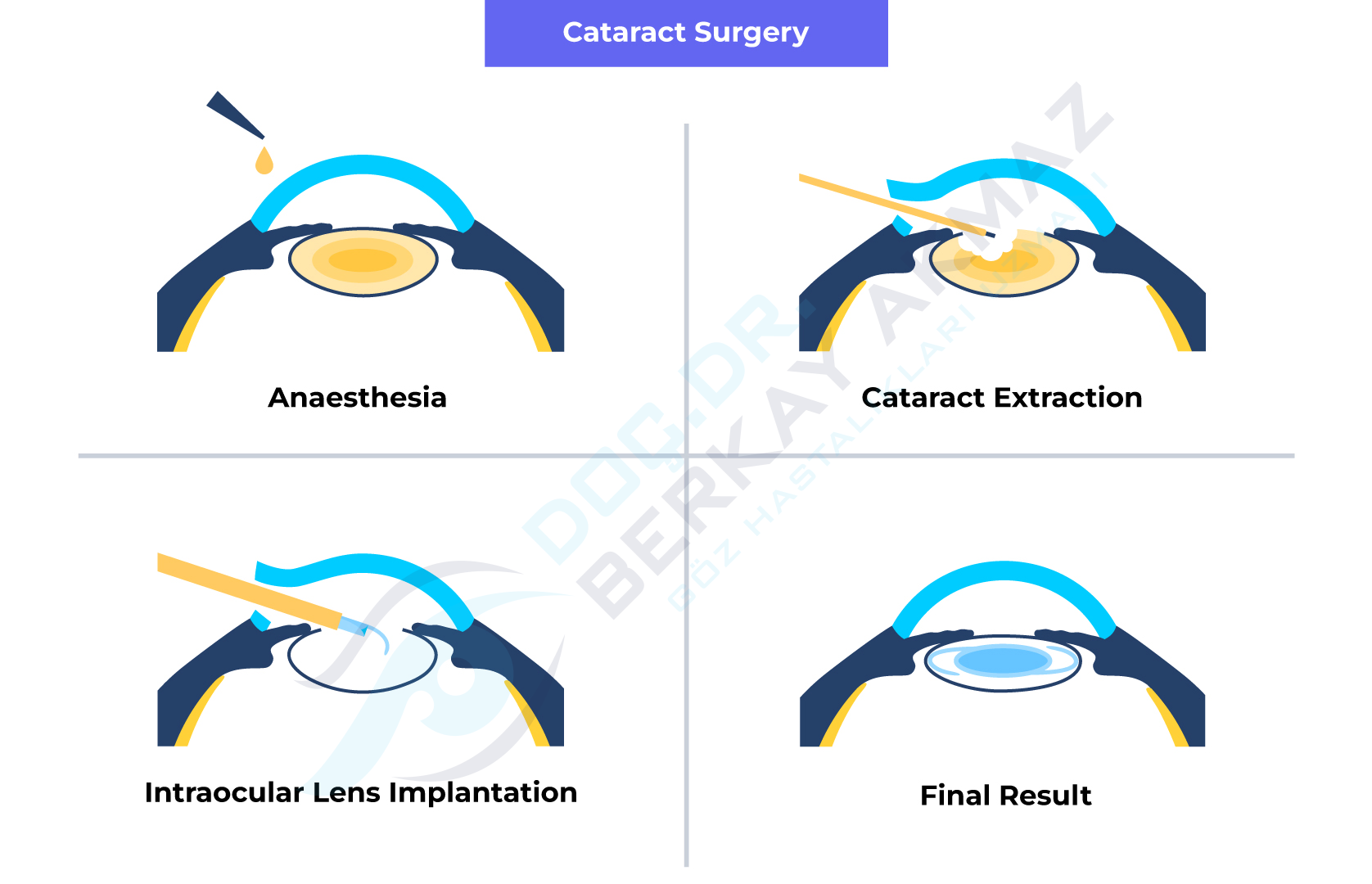 Cataract surgery steps