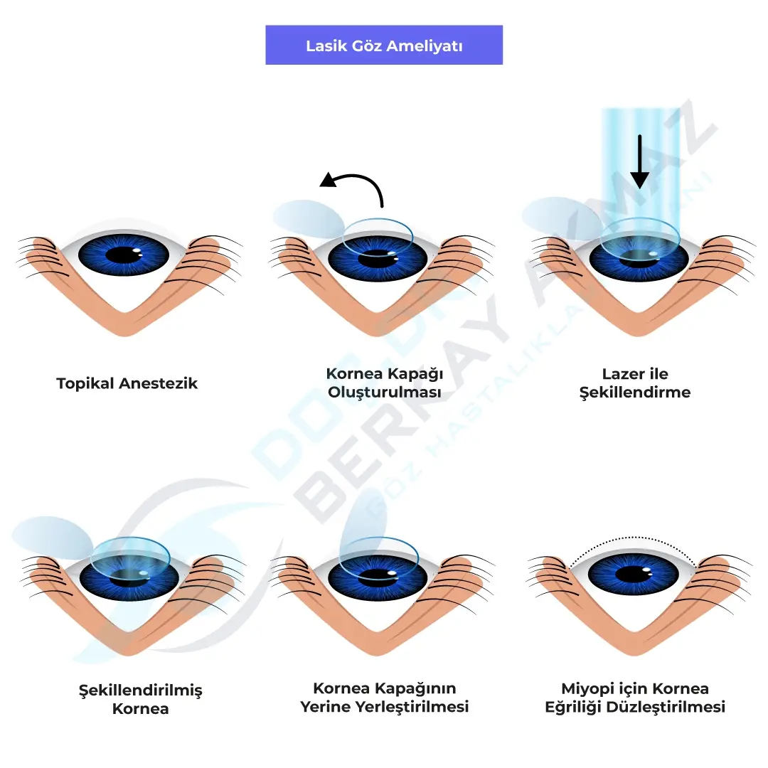 Lasik goz ameliyati Lasik Göz Ameliyatı Lasik göz ameliyatı süreci