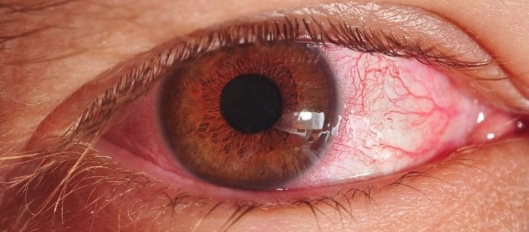 Göz Nezlesi Nedir? Göz Nezlesi Belirtileri Nelerdir?
