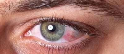 Goz Sulanmasi Neden Olur Goz Sulanmasina Ne Iyi Gelir What Causes Watery Eyes? What Is Good For Watery Eyes?