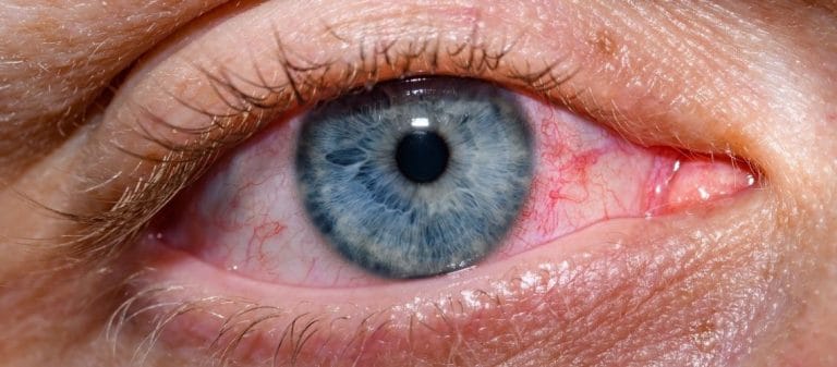 Göz Kızarıklığına Ne İyi Gelir? Nasıl Geçer?
