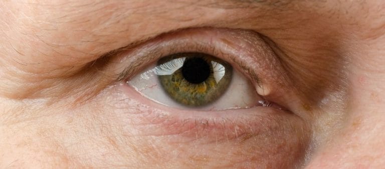 Şalazyon (Göz Kapağı Kisti) Nedir? Şalazyon Belirtileri ve Tedavisi