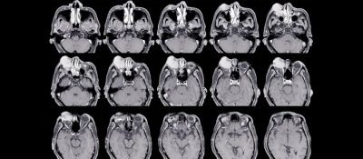 Psodotumor Serebri Pseudotumor Cerebri: Ursachen, Symptome und Behandlung