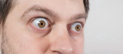Ekzoftalmi Nedir Exophthalmus: Ursachen, Symptome und Behandlung
