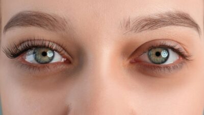 Goz Alti Morluklari Nasil Gecer How Do Under-Eye Dark Circles Go Away?