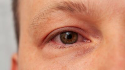 Papilodem Nedir Optik Sinir Sismesi Belirtileri ve Tedavisi Papilödem Nedir? Optik Sinir Şişmesi Belirtileri ve Tedavisi
